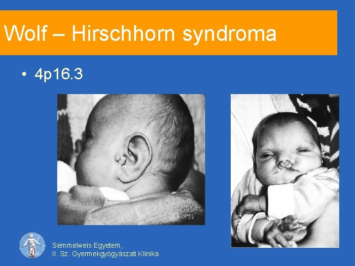 Wolf – Hirschhorn syndroma • 4 p 16. 3 Semmelweis Egyetem, II. Sz. Gyermekgyógyászati