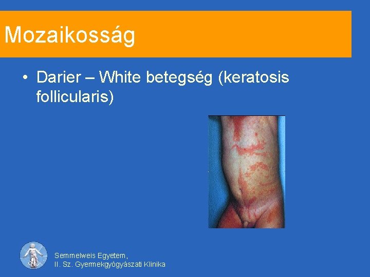 Mozaikosság • Darier – White betegség (keratosis follicularis) Semmelweis Egyetem, II. Sz. Gyermekgyógyászati Klinika