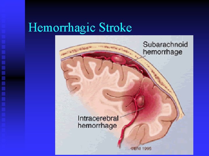 Hemorrhagic Stroke 