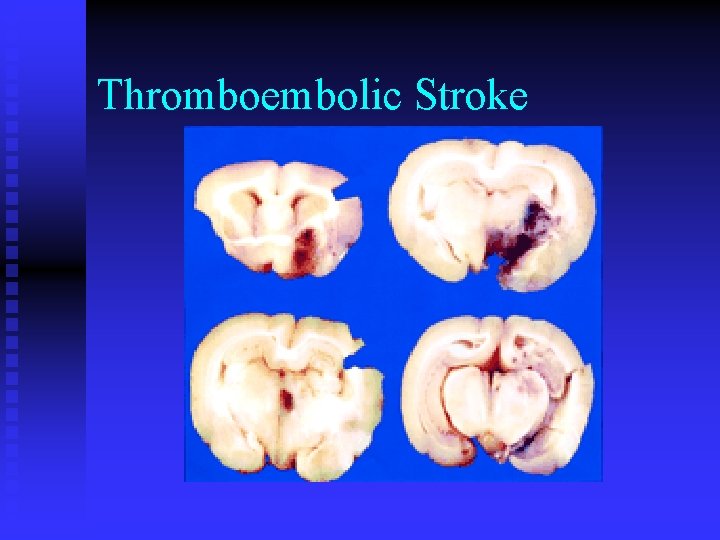 Thromboembolic Stroke 