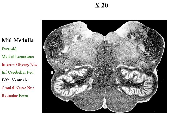 X 20 Mid Medulla Pyramid Medial Lemniscus Inferior Olivary Nuc Inf Cerebellar Ped IVth