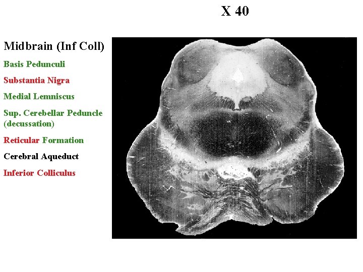 X 40 Midbrain (Inf Coll) Basis Pedunculi Substantia Nigra Medial Lemniscus Sup. Cerebellar Peduncle