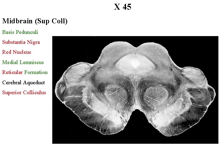 X 45 Midbrain (Sup Coll) Basis Pedunculi Substantia Nigra Red Nucleus Medial Lemniscus Reticular