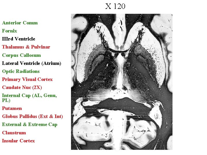 X 120 Anterior Comm Fornix IIIrd Ventricle Thalamus & Pulvinar Corpus Callosum Lateral Ventricle