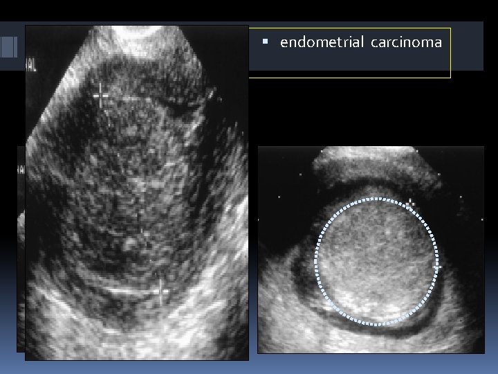 anc endometrial carcinoma 