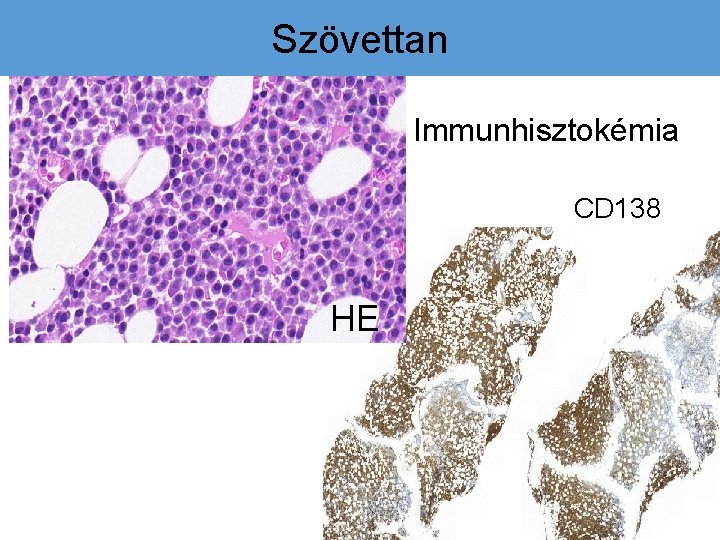 Szövettan Immunhisztokémia CD 138 HE 