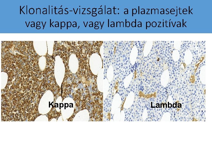 Klonalitás-vizsgálat: a plazmasejtek vagy kappa, vagy lambda pozitívak Kappa Lambda 