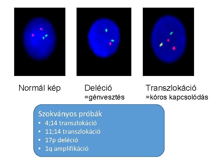 Normál kép Deléció Transzlokáció =génvesztés =kóros kapcsolódás Szokványos próbák • • 4; 14 transzlokáció