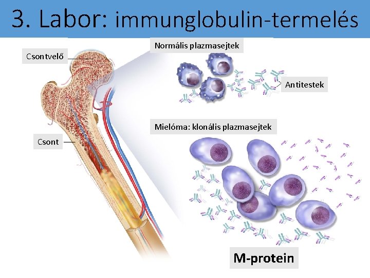 3. Labor: immunglobulin-termelés Csontvelő Normális plazmasejtek Antitestek Mielóma: klonális plazmasejtek Csont M-protein 