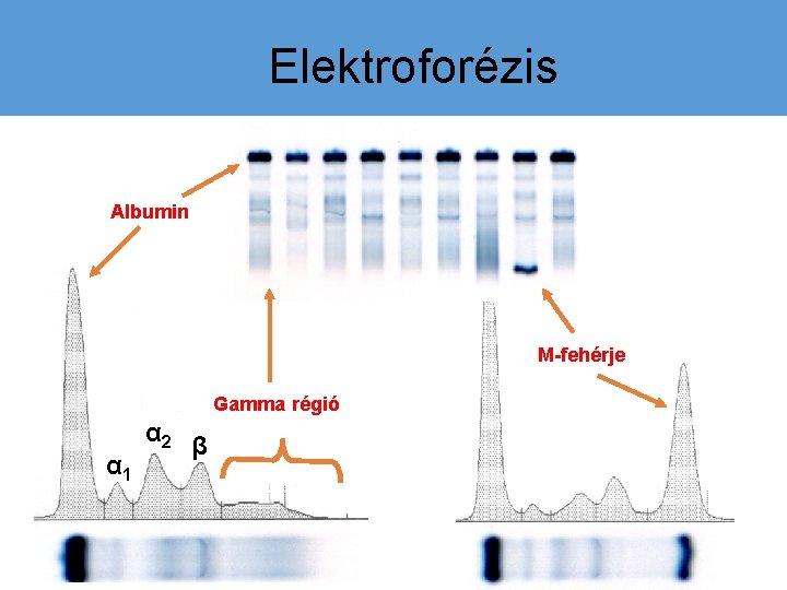 Elektroforézis Albumin M-fehérje Gamma régió α 1 α 2 β 