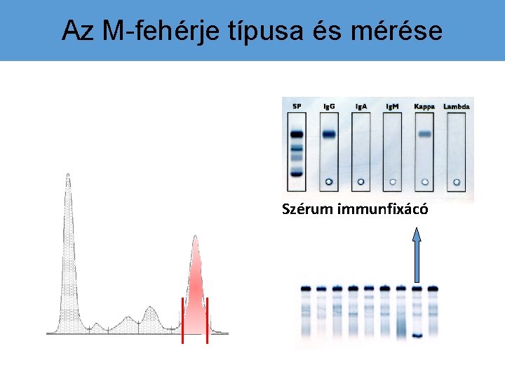 Az M-fehérje típusa és mérése Szérum immunfixácó 