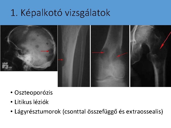 1. Képalkotó vizsgálatok • Oszteoporózis • Litikus léziók • Lágyrésztumorok (csonttal összefüggő és extraossealis)