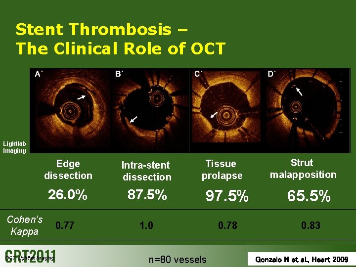 Stent Thrombosis – The Clinical Role of OCT Lightlab Imaging Intra-stent dissection 26. 0%