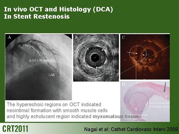 In vivo OCT and Histology (DCA) In Stent Restenosis The hyperechoic regions on OCT