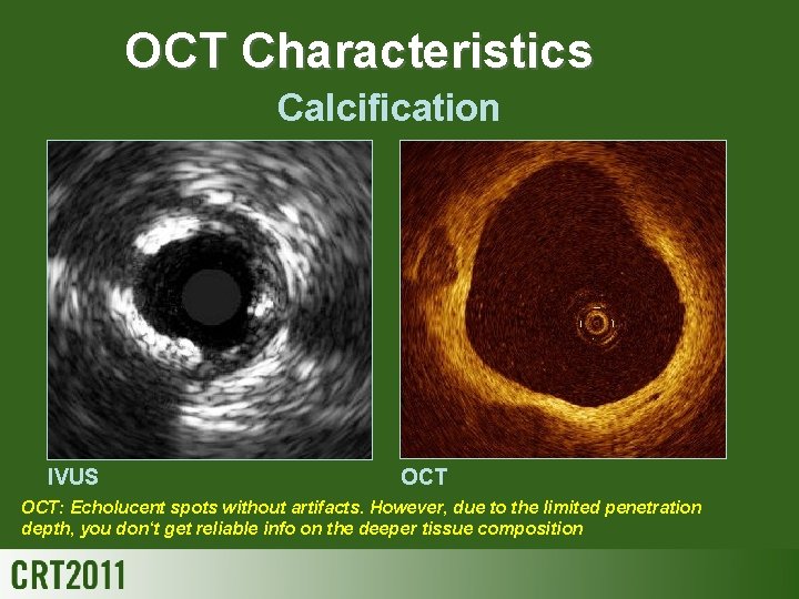 OCT Characteristics Calcification IVUS OCT: Echolucent spots without artifacts. However, due to the limited