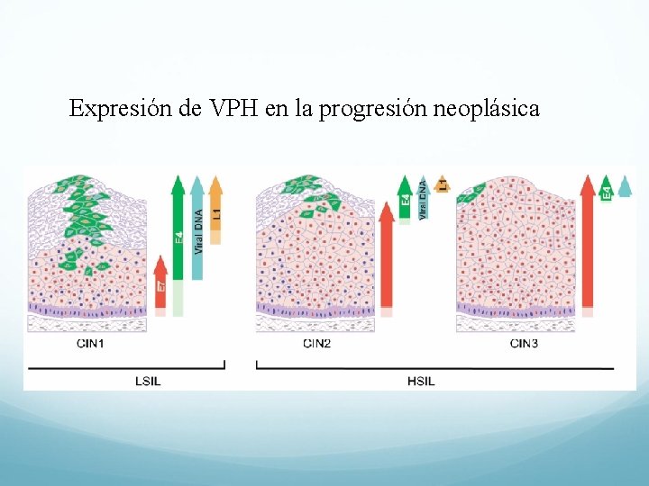 Expresión de VPH en la progresión neoplásica 