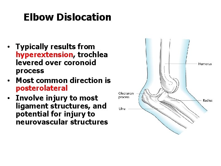 Elbow Dislocation • Typically results from hyperextension, trochlea levered over coronoid process • Most