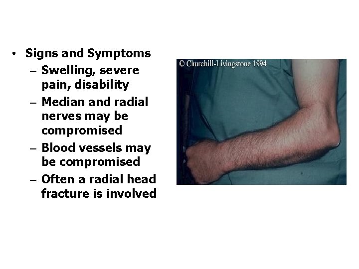  • Signs and Symptoms – Swelling, severe pain, disability – Median and radial