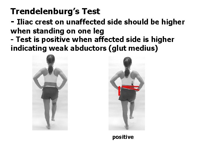 Trendelenburg’s Test - Iliac crest on unaffected side should be higher when standing on