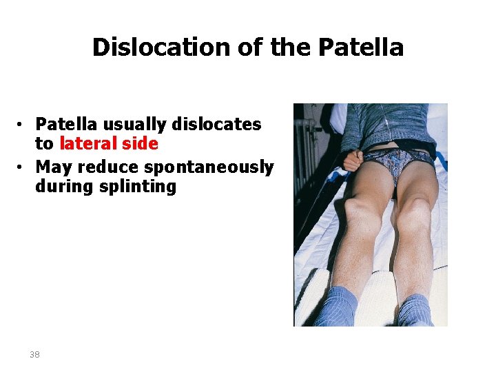 Dislocation of the Patella • Patella usually dislocates to lateral side • May reduce