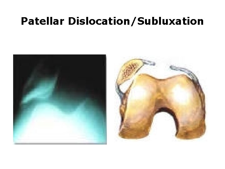 Patellar Dislocation/Subluxation Patellar Dislocation/Subluxation