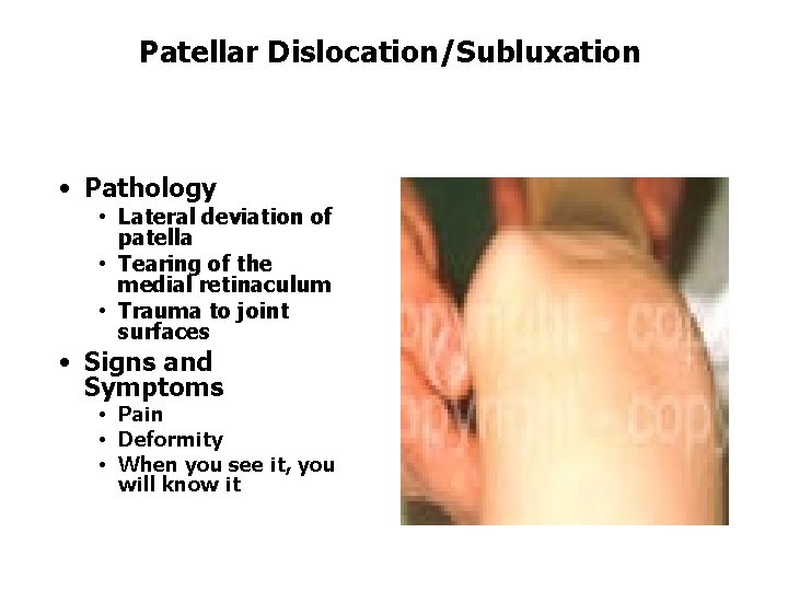 Patellar Dislocation/Subluxation • Pathology • Lateral deviation of patella • Tearing of the medial Patellar Dislocation/Subluxation • Pathology • Lateral deviation of patella • Tearing of the medial