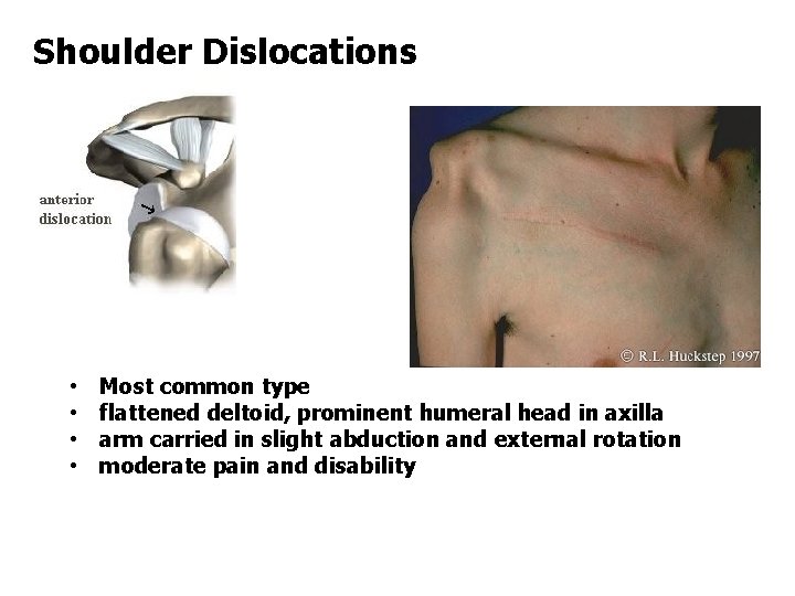 Shoulder Dislocations • • Most common type flattened deltoid, prominent humeral head in axilla