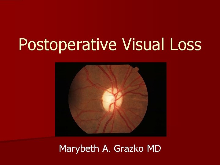 Postoperative Visual Loss Marybeth A. Grazko MD 