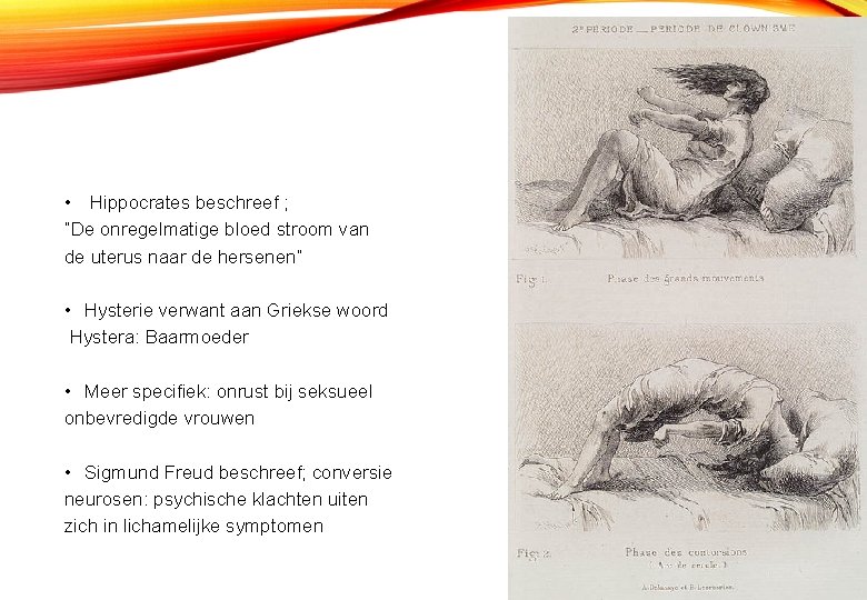 HYSTERIE • Hippocrates beschreef ; “De onregelmatige bloed stroom van de uterus naar de