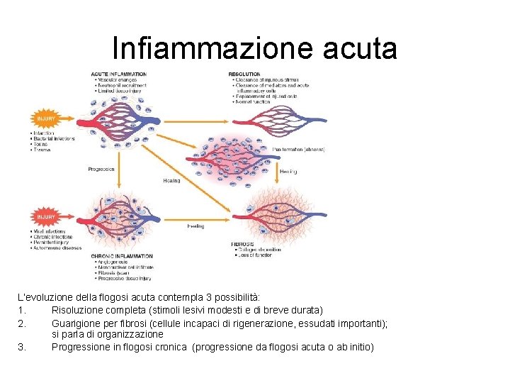 Infiammazione acuta L’evoluzione della flogosi acuta contempla 3 possibilità: 1. Risoluzione completa (stimoli lesivi