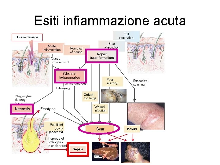 Esiti infiammazione acuta 