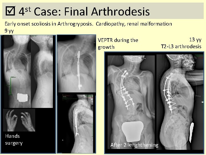  4 st Case: Final Arthrodesis Early onset scoliosis in Arthrogryposis. Cardiopathy, renal malformation