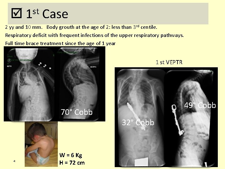  1 st Case 2 yy and 10 mm. Body grouth at the age