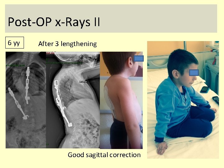 Post-OP x-Rays II 6 yy After 3 lengthening Good sagittal correction 