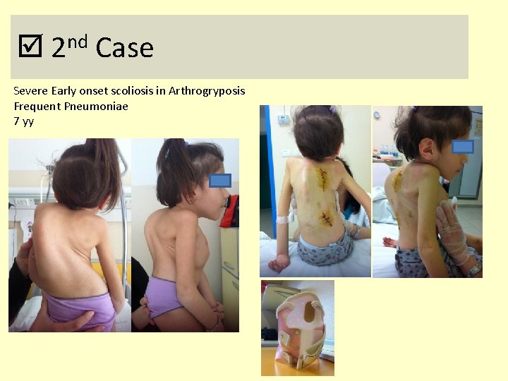  2 nd Case Severe Early onset scoliosis in Arthrogryposis Frequent Pneumoniae 7 yy