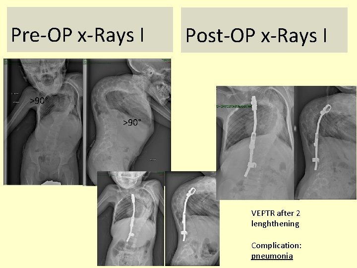 Pre-OP x-Rays I Post-OP x-Rays I >90° VEPTR after 2 lenghthening Complication: pneumonia 