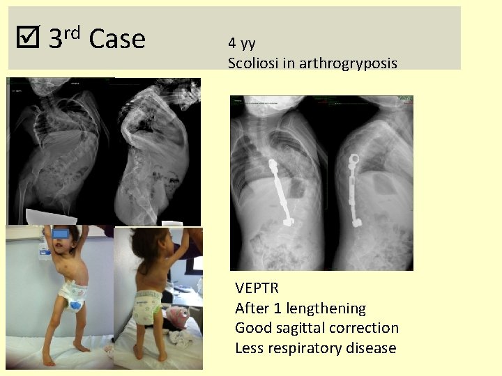 rd 3 Case 4 yy Scoliosi in arthrogryposis VEPTR After 1 lengthening Good sagittal