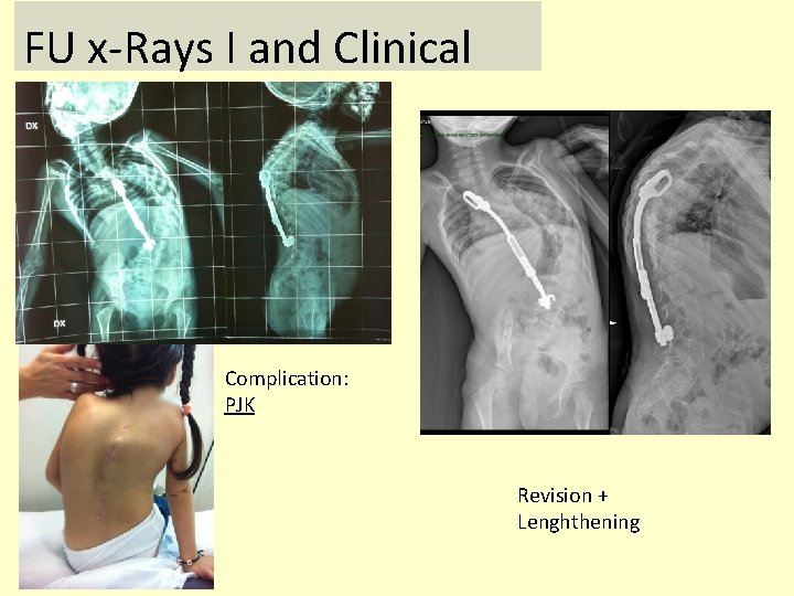 FU x-Rays I and Clinical Complication: PJK Revision + Lenghthening 
