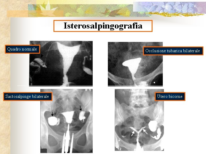 Isterosalpingografia Quadro normale Sactosalpinge bilaterale Occlusione tubarica bilaterale Utero bicorne 