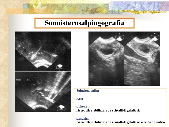 Sonoisterosalpingografia -Soluzione salina -Aria -Echovist: microbolle stabilizzate da cristalli di galattosio -Levovist: microbolle stabilizzate