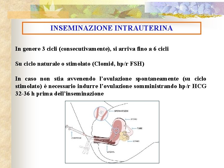 INSEMINAZIONE INTRAUTERINA In genere 3 cicli (consecutivamente), si arriva fino a 6 cicli Su