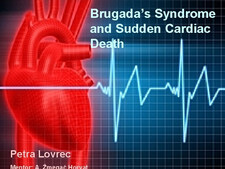 Brugada’s Syndrome and Sudden Cardiac Death Petra Lovrec 