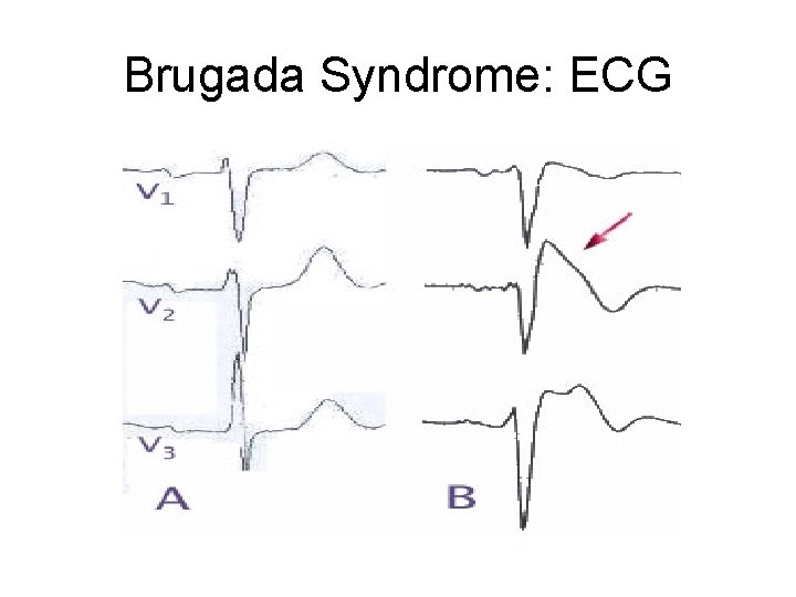 Brugadas Syndrome and Sudden Cardiac Death Petra Lovrec
