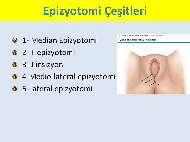 Epizyotomi Çeşitleri 1 - Median Epizyotomi 2 - T epizyotomi 3 - J insizyon