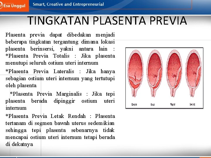 TINGKATAN PLASENTA PREVIA Plasenta previa dapat dibedakan menjadi beberapa tingkatan tergantung dimana lokasi plasenta TINGKATAN PLASENTA PREVIA Plasenta previa dapat dibedakan menjadi beberapa tingkatan tergantung dimana lokasi plasenta