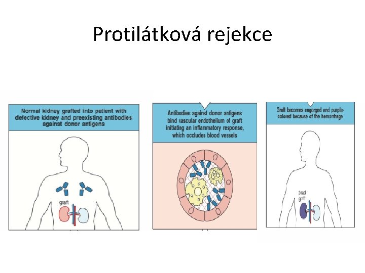 Protilátková rejekce 