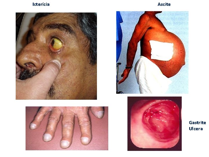 Icterícia Ascite Gastrite Ulcera 