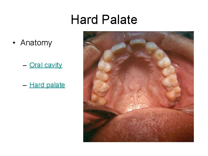 Hard Palate • Anatomy – Oral cavity – Hard palate 