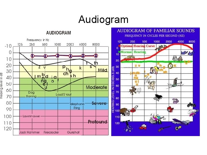 Audiogram 