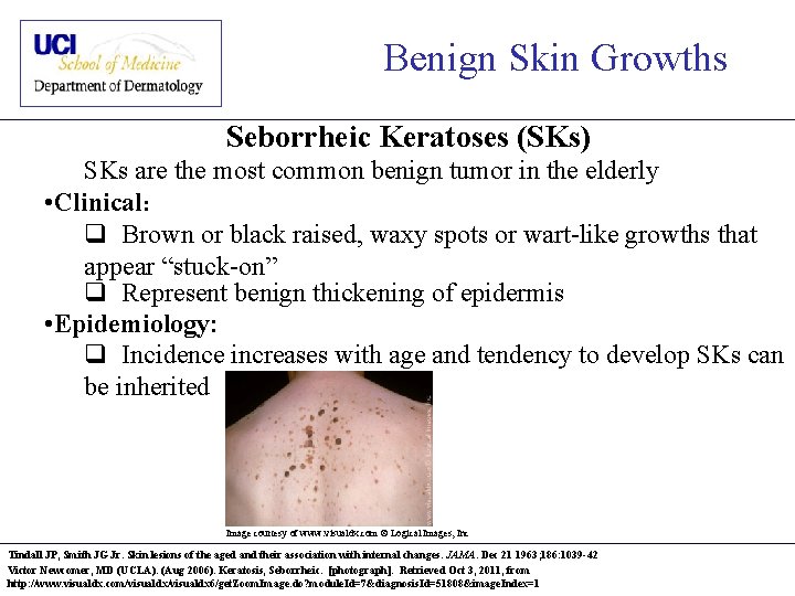 Benign Skin Growths Seborrheic Keratoses (SKs) SKs are the most common benign tumor in